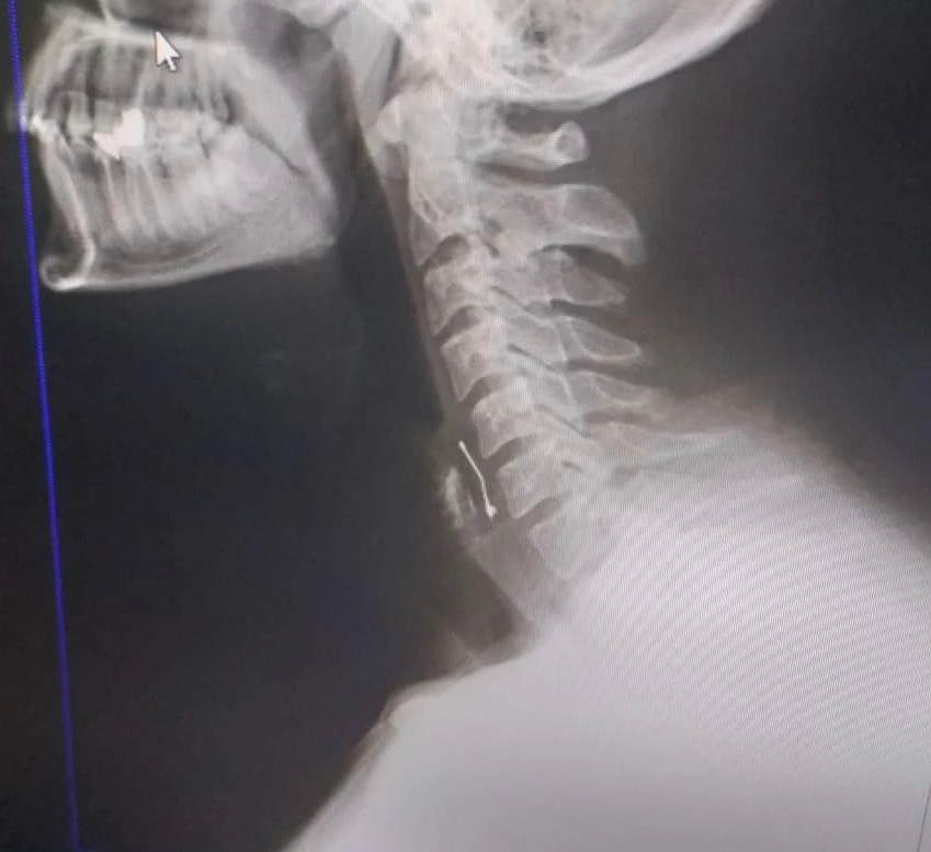 Doğum günü pastası yerken boğazına toplu iğne saplandı